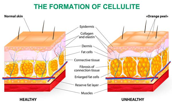 cellulite